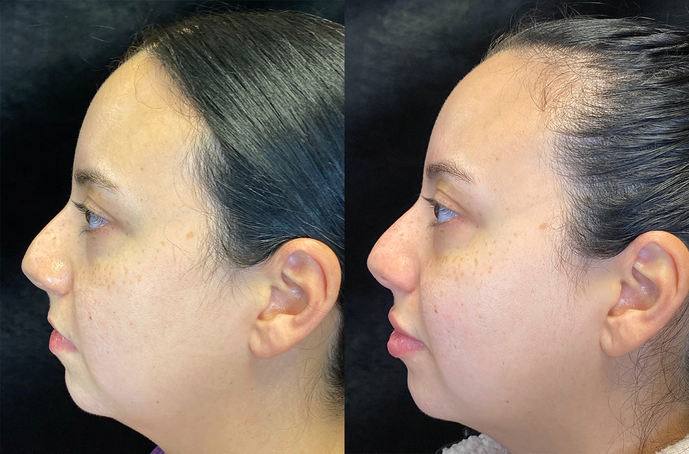 Dermal Fillers Before & After Gallery - Patient 147538369 - Image 5