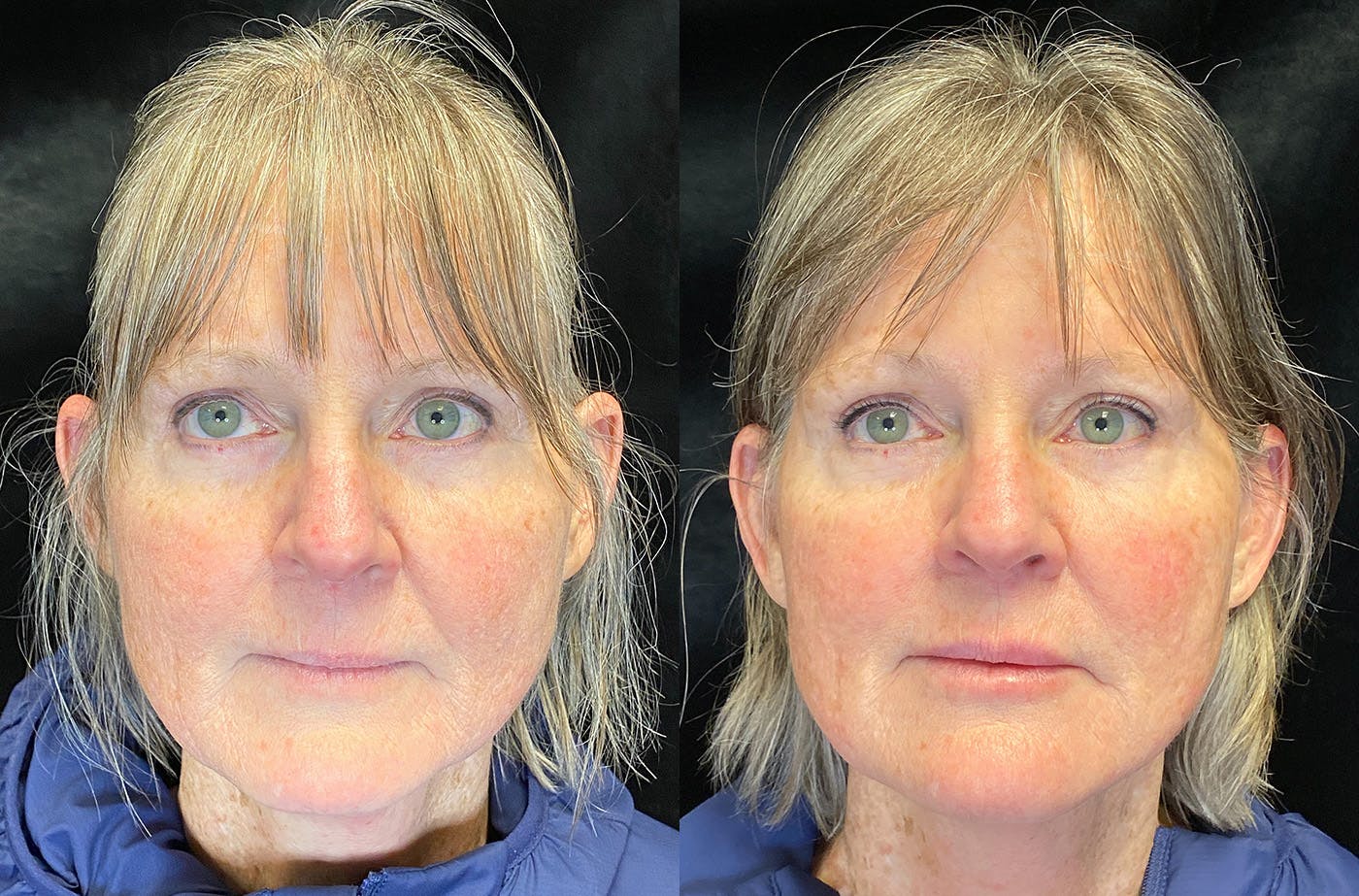 BOTOX/Dysport Before & After Gallery - Patient 148147338 - Image 1