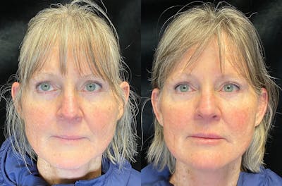 Dermal Fillers Before & After Gallery - Patient 148147337 - Image 1