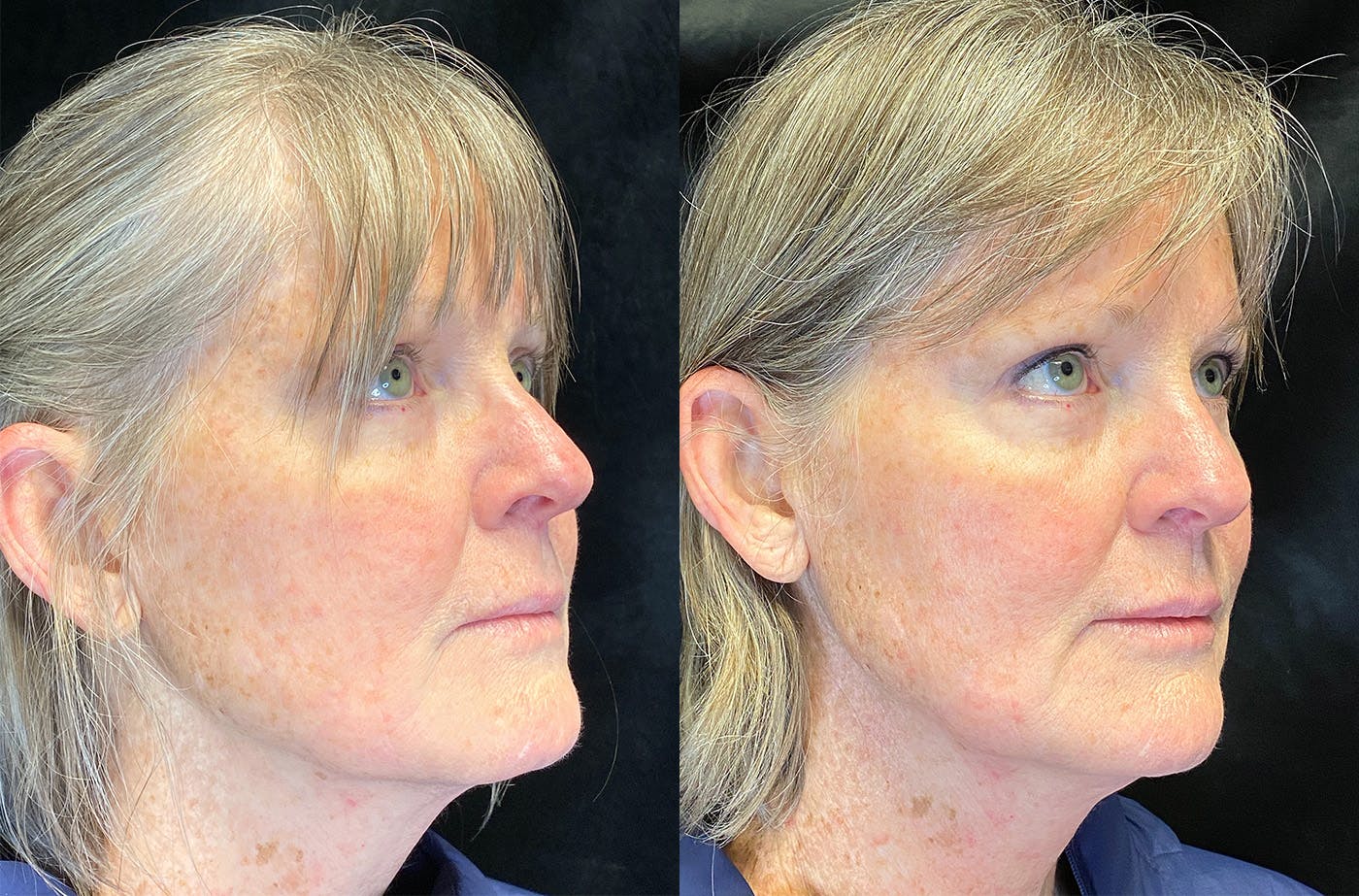 BOTOX/Dysport Before & After Gallery - Patient 148147338 - Image 2