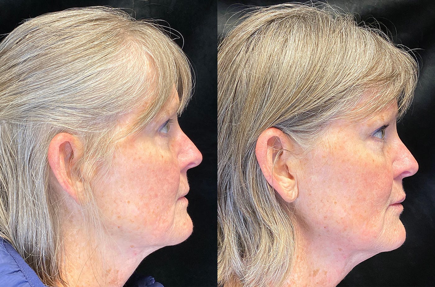 BOTOX/Dysport Before & After Gallery - Patient 148147338 - Image 3