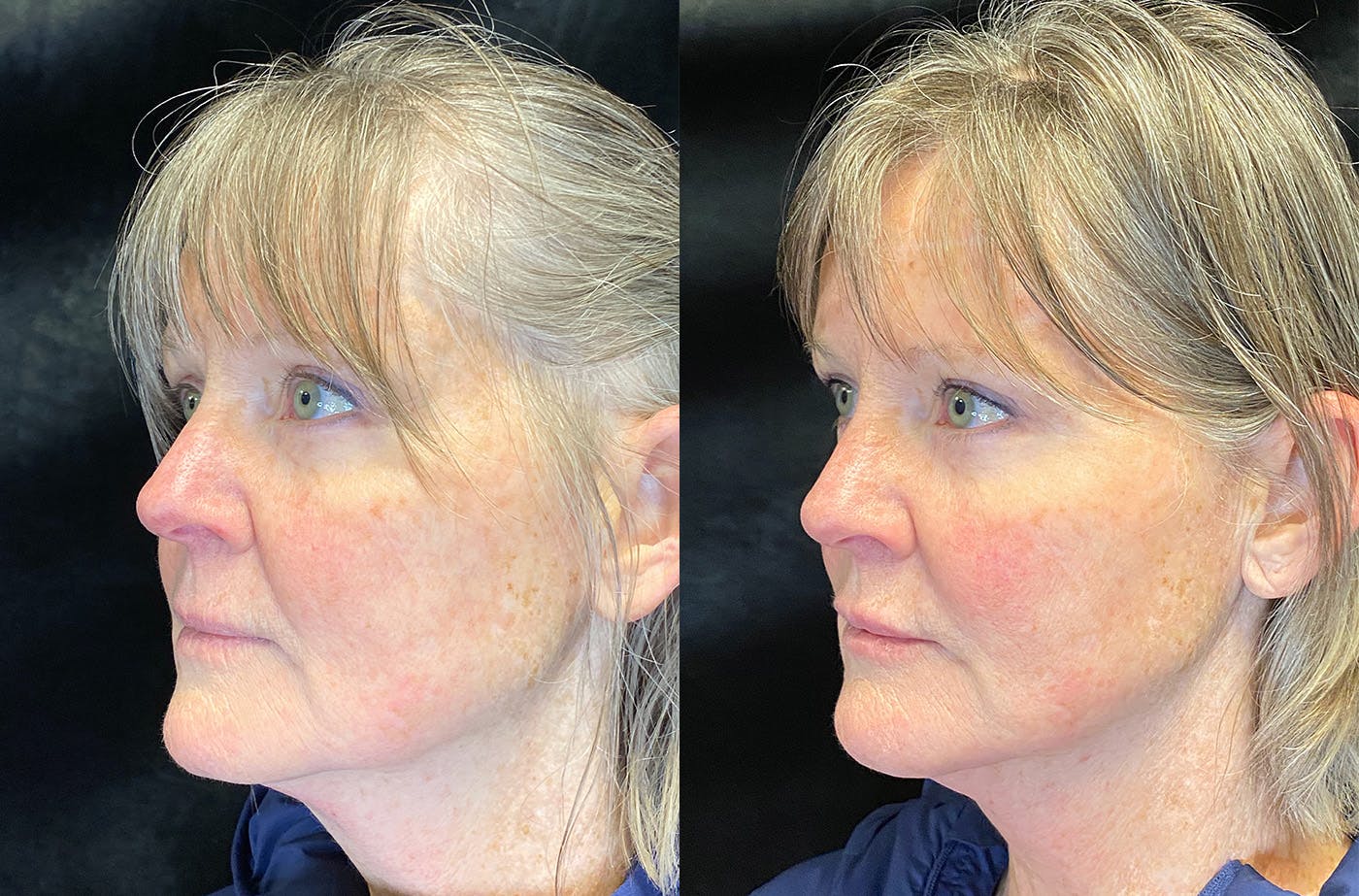 Dermal Fillers Before & After Gallery - Patient 148147337 - Image 4