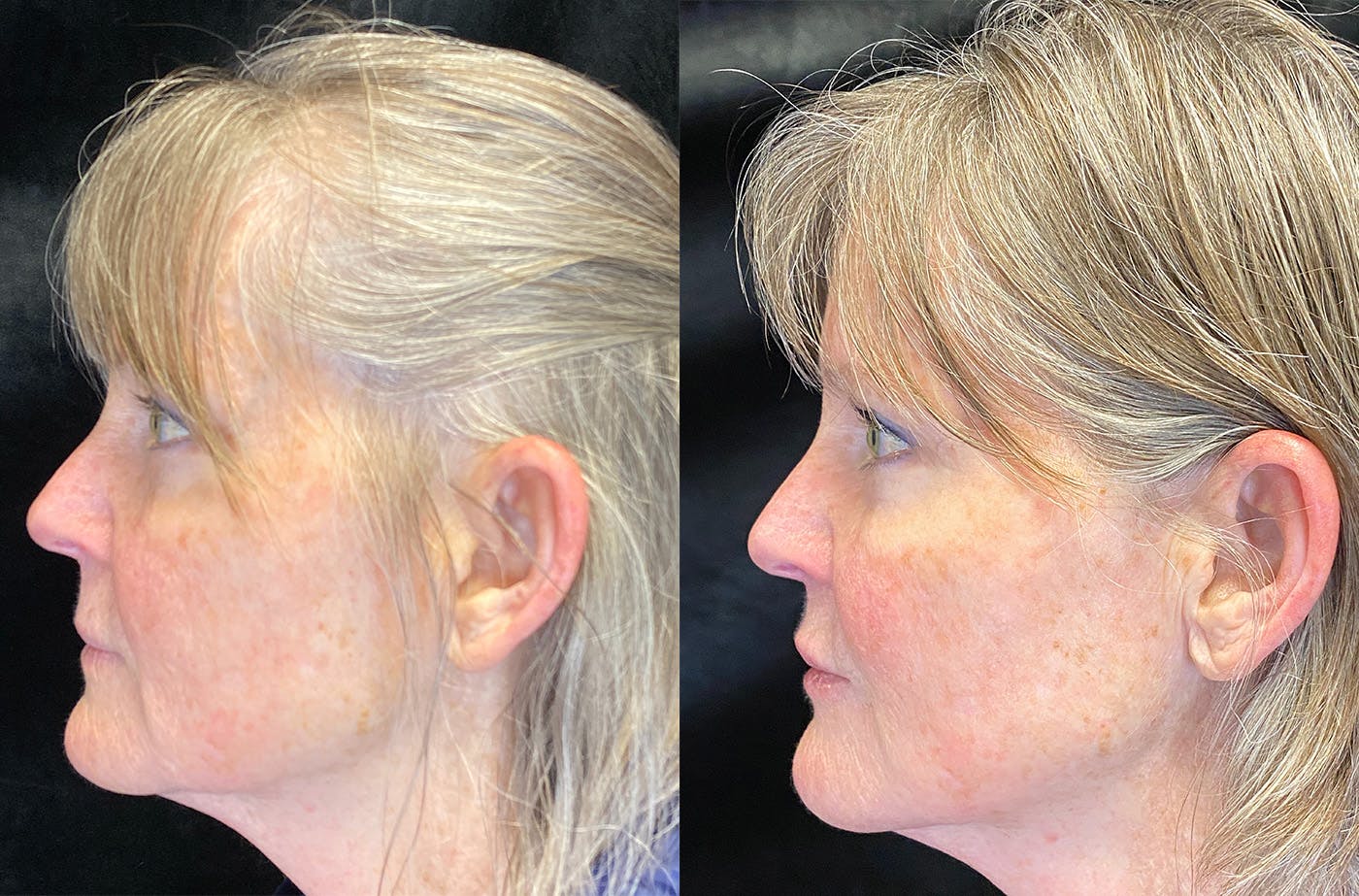 BOTOX/Dysport Before & After Gallery - Patient 148147338 - Image 5