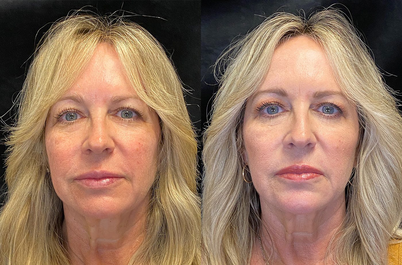 BOTOX/Dysport Before & After Gallery - Patient 148255700 - Image 1
