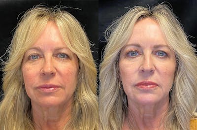 BOTOX/Dysport Before & After Gallery - Patient 148255700 - Image 1