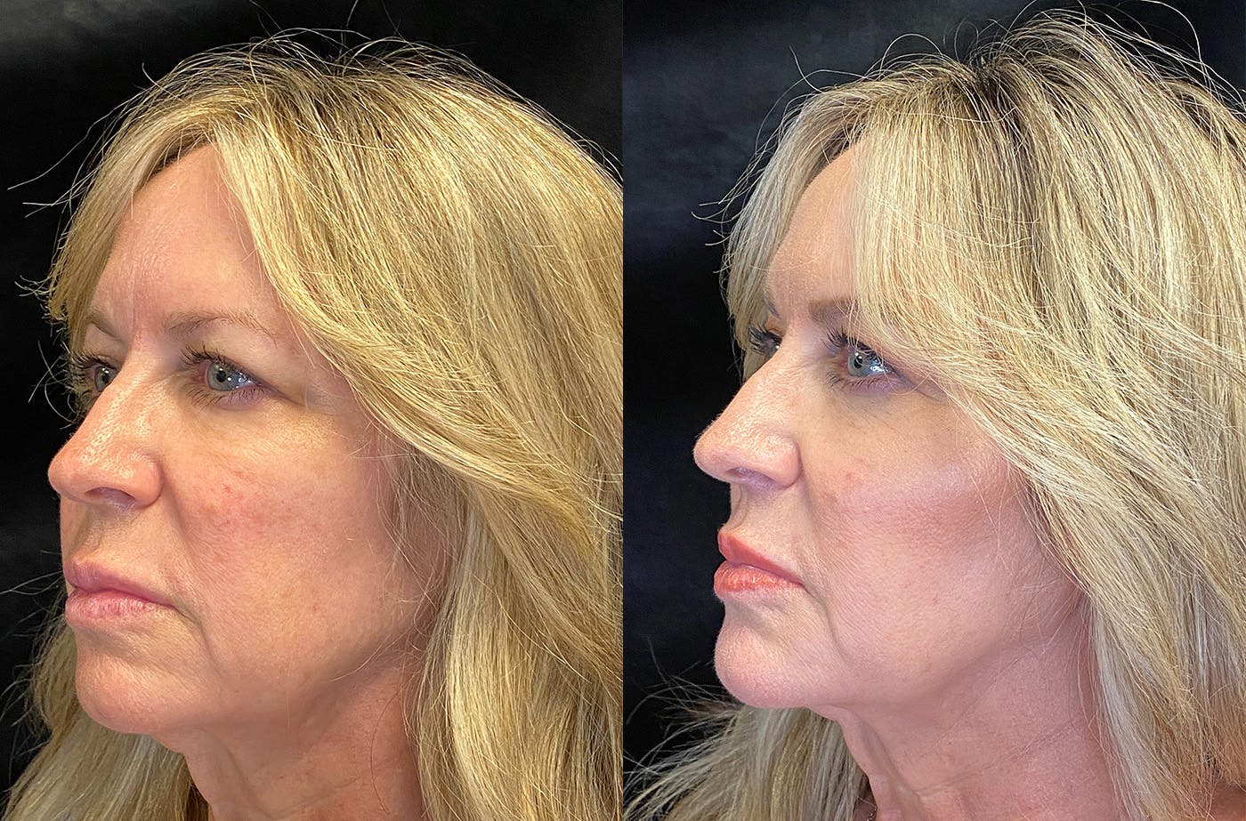 BOTOX/Dysport Before & After Gallery - Patient 148255700 - Image 2