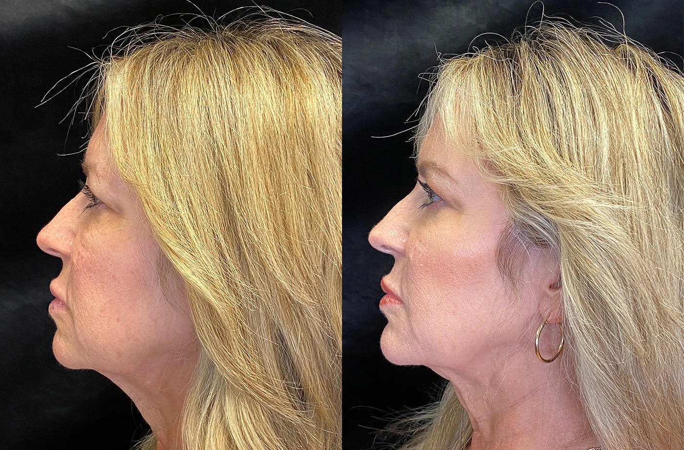 Dermal Fillers Before & After Gallery - Patient 148255699 - Image 3