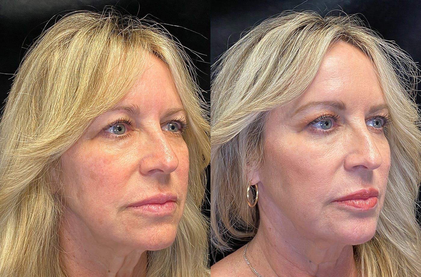 BOTOX/Dysport Before & After Gallery - Patient 148255700 - Image 4