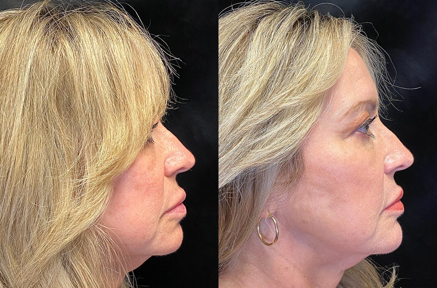 Dermal Fillers Before & After Gallery - Patient 148255699 - Image 5