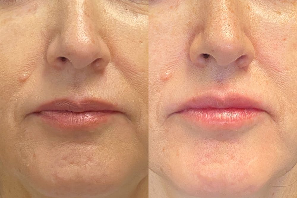 Dermal Fillers Before & After Gallery - Patient 148257636 - Image 1