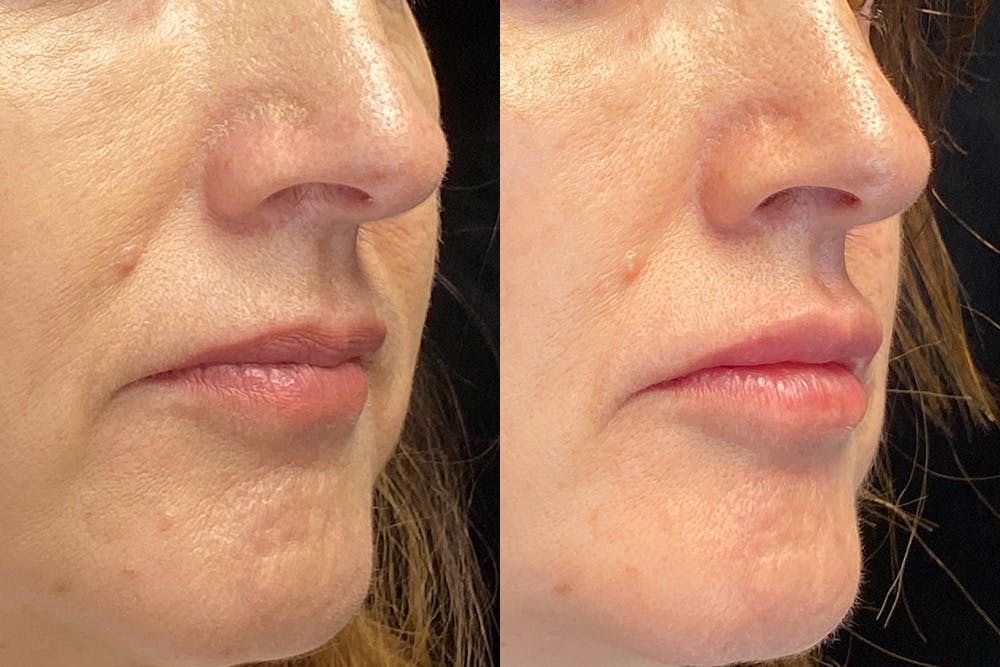 Dermal Fillers Before & After Gallery - Patient 148257636 - Image 2
