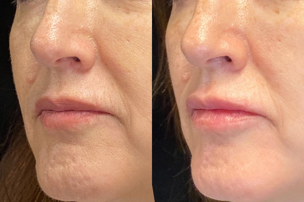 Dermal Fillers Before & After Gallery - Patient 148257636 - Image 3