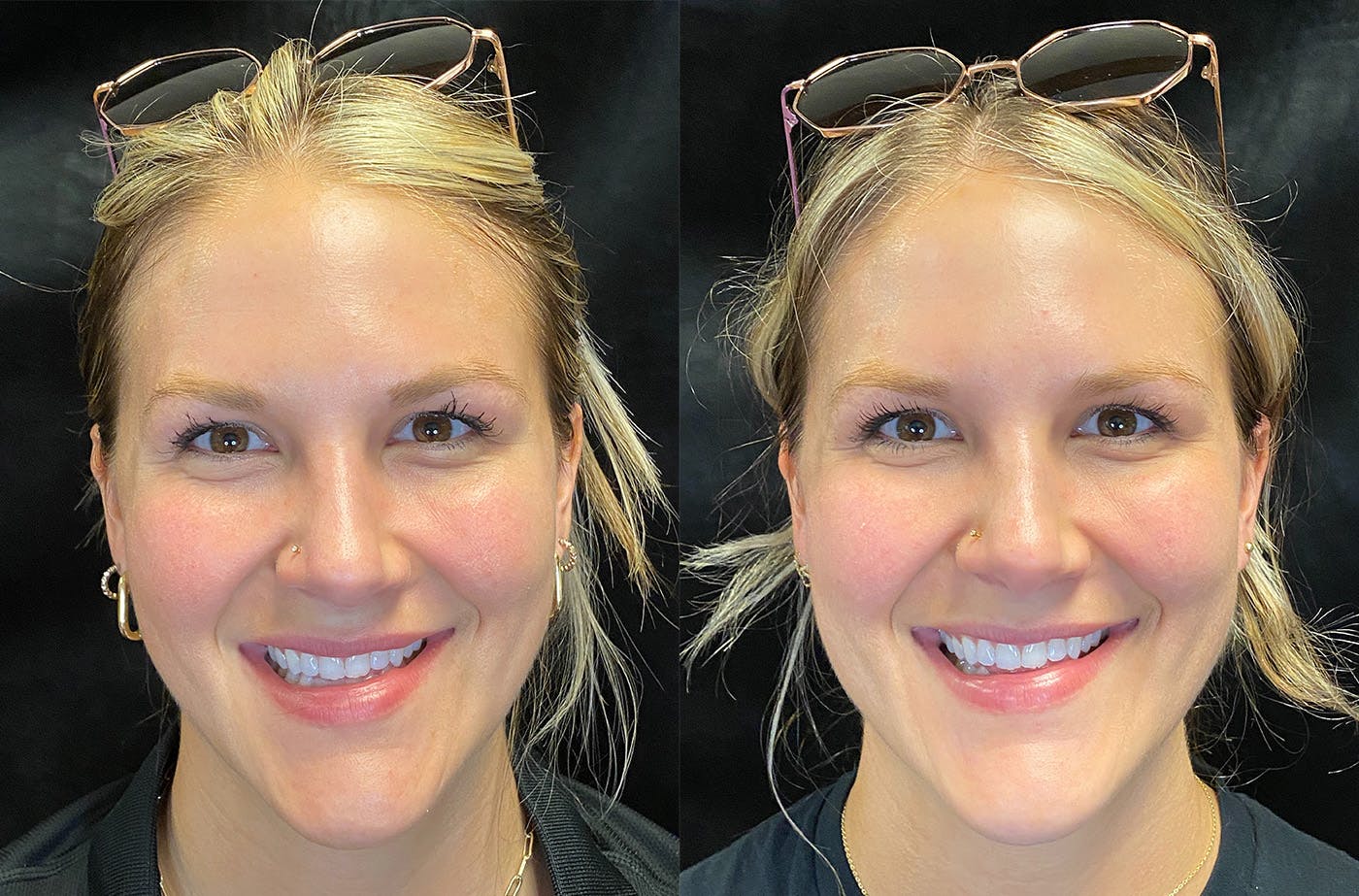Dermal Fillers Before & After Gallery - Patient 148703607 - Image 1