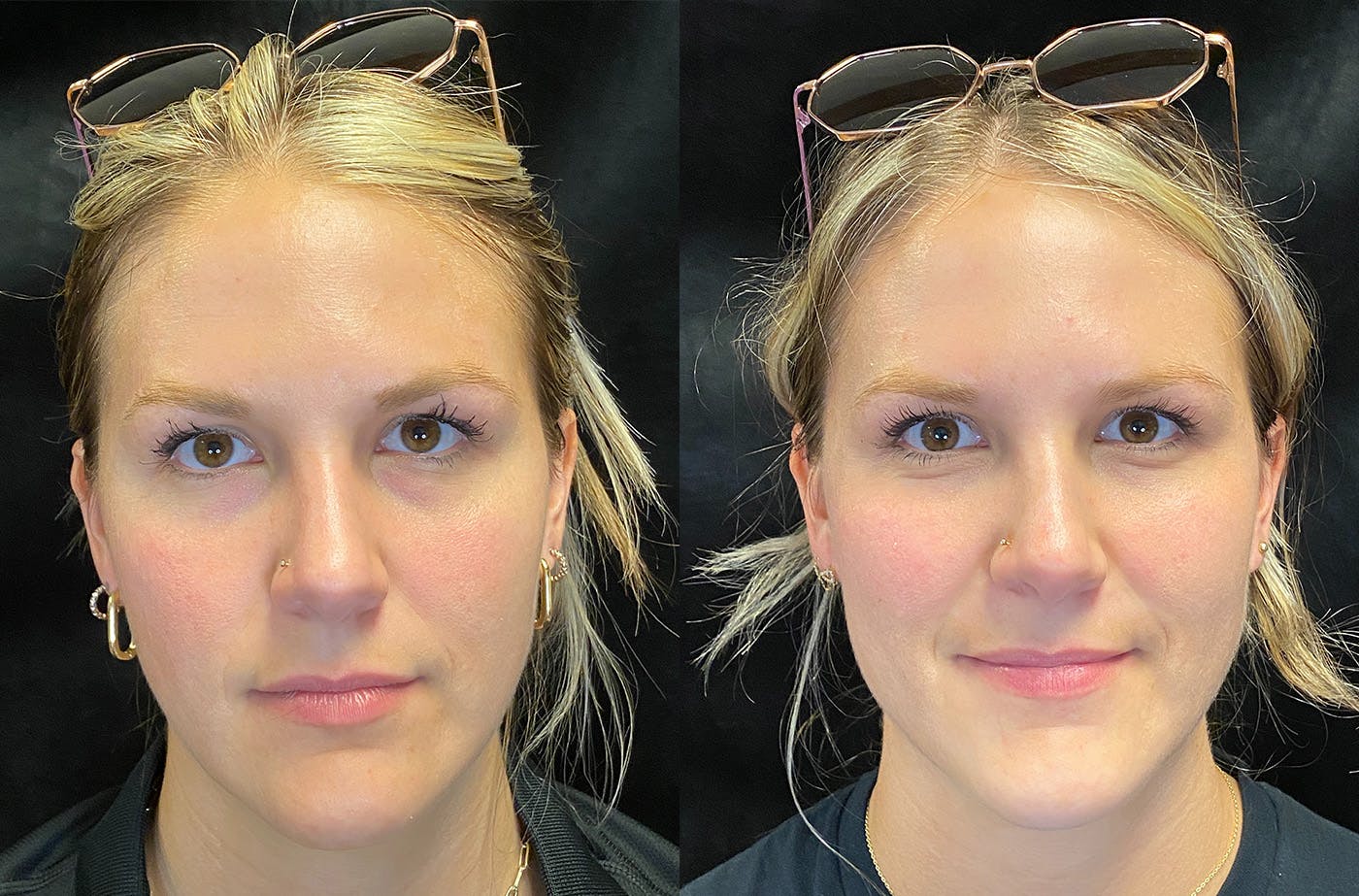Dermal Fillers Before & After Gallery - Patient 148703607 - Image 2