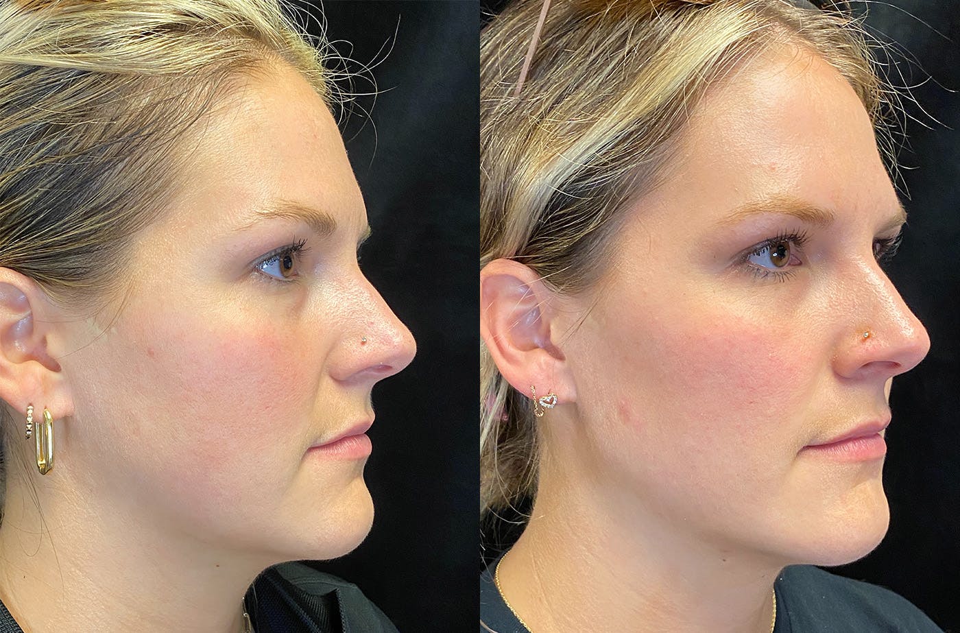 Dermal Fillers Before & After Gallery - Patient 148703607 - Image 3