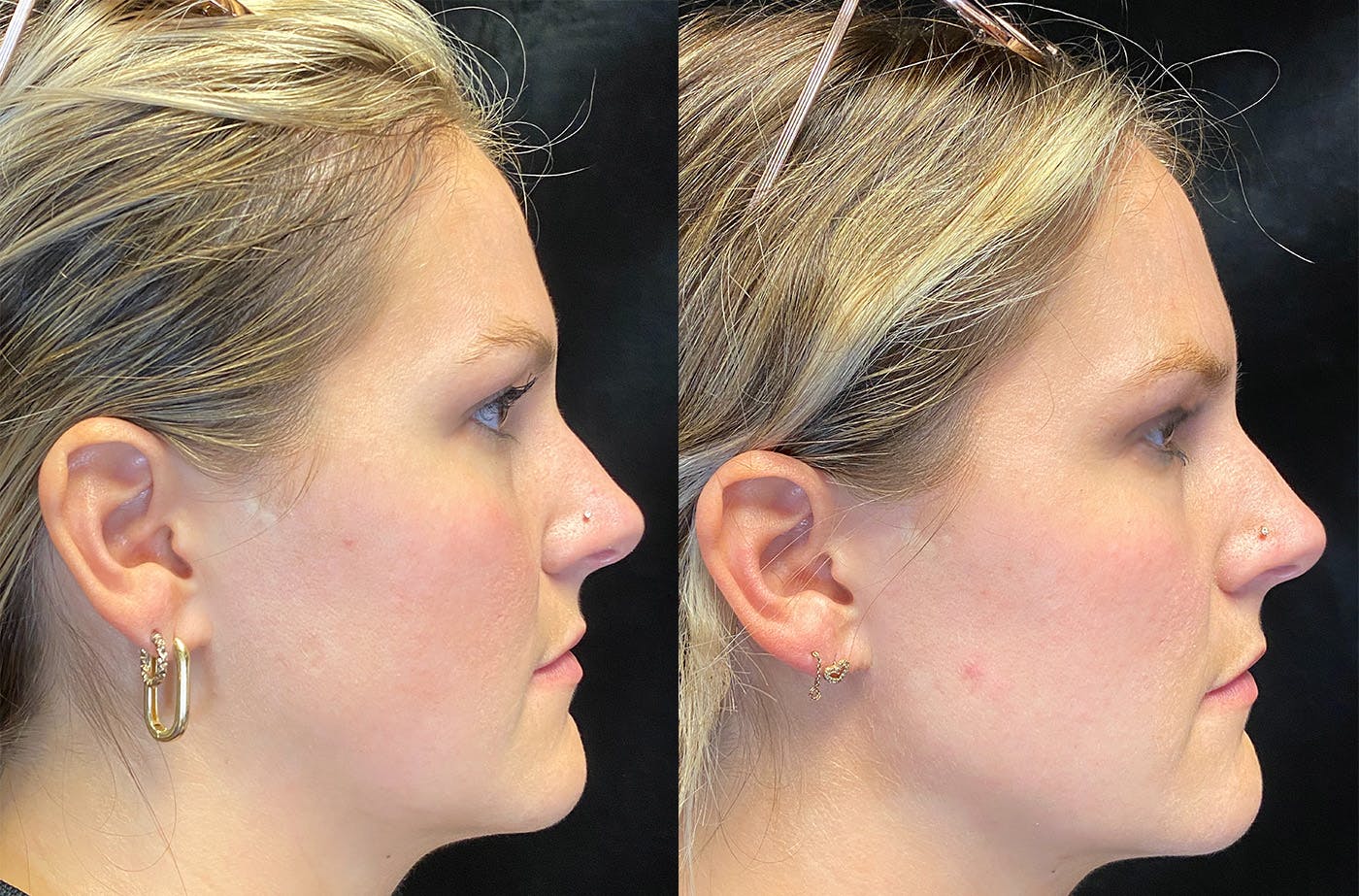 Dermal Fillers Before & After Gallery - Patient 148703607 - Image 4
