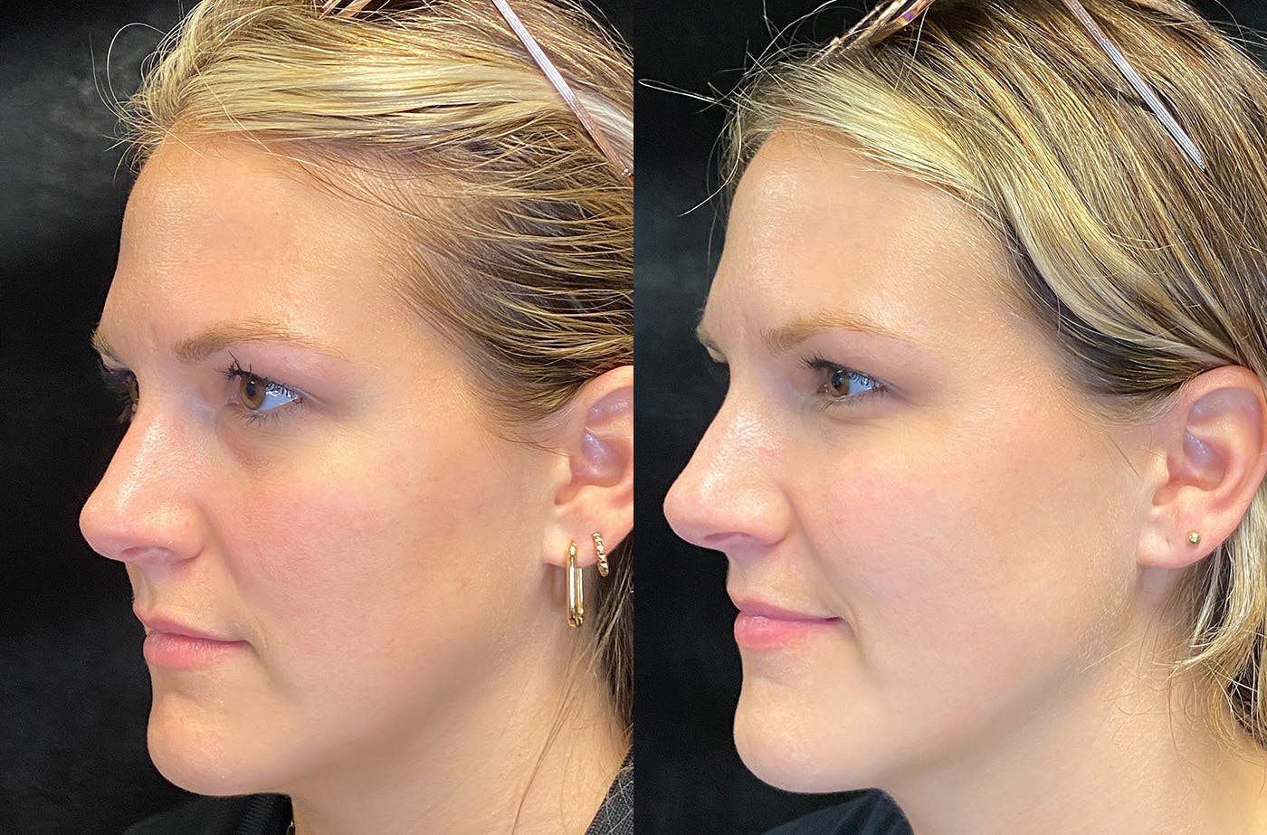 Dermal Fillers Before & After Gallery - Patient 148703607 - Image 5