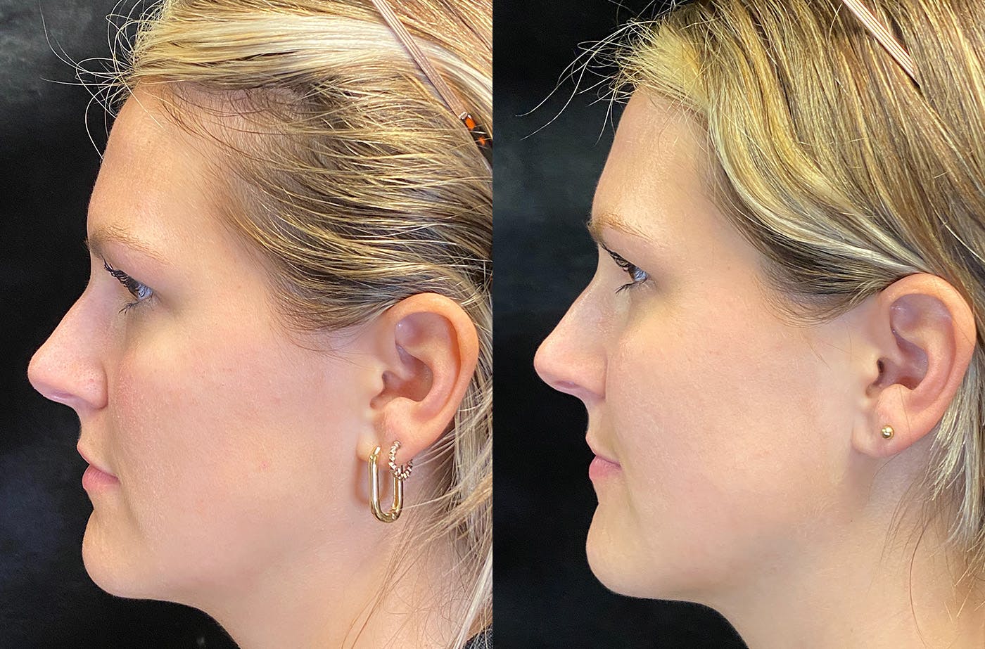 Dermal Fillers Before & After Gallery - Patient 148703607 - Image 6