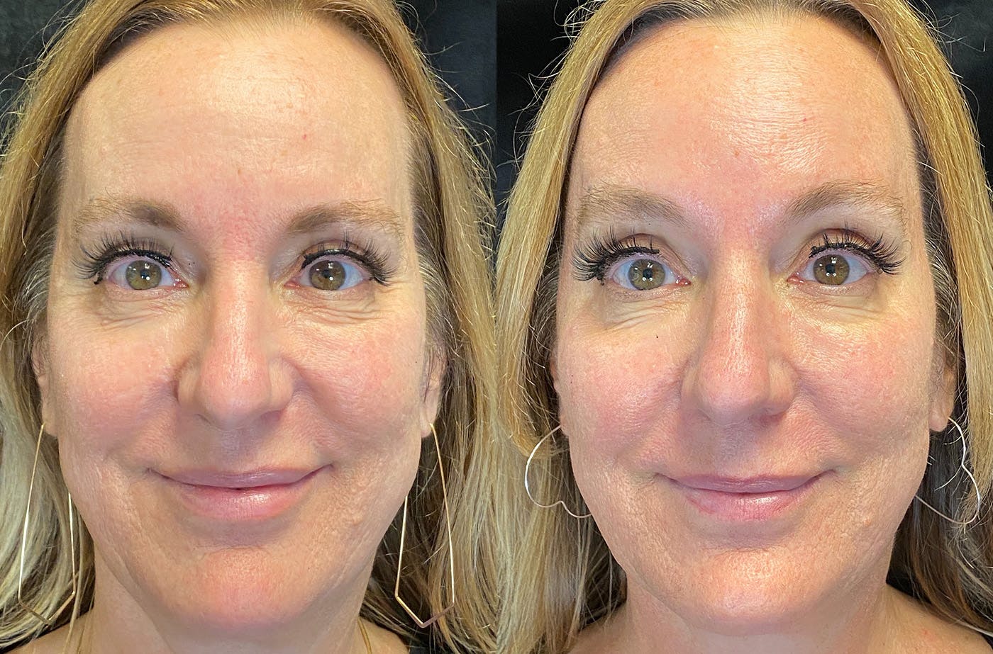 BOTOX/Dysport Before & After Gallery - Patient 148734832 - Image 1