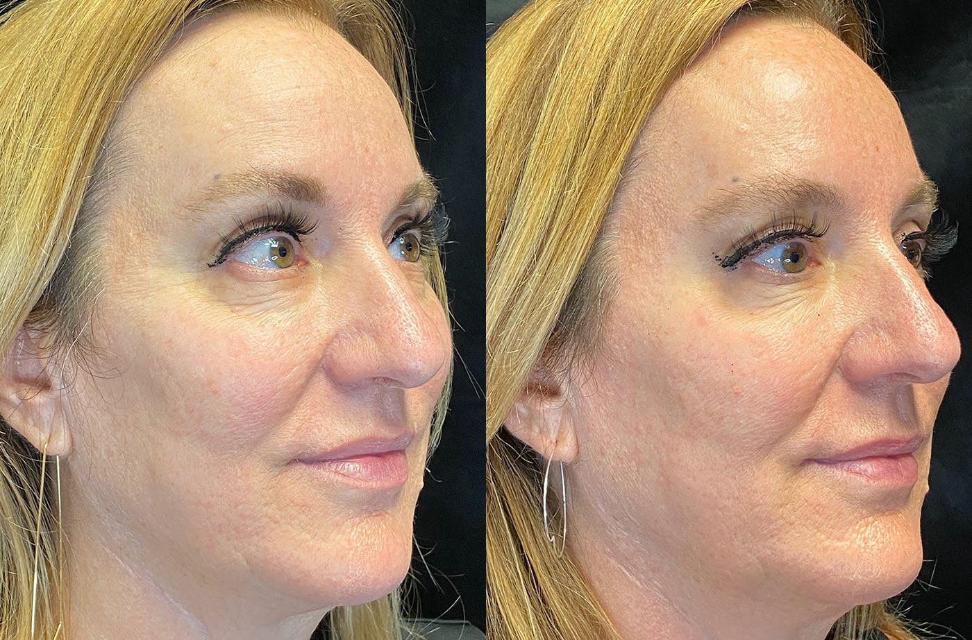 BOTOX/Dysport Before & After Gallery - Patient 148734832 - Image 2