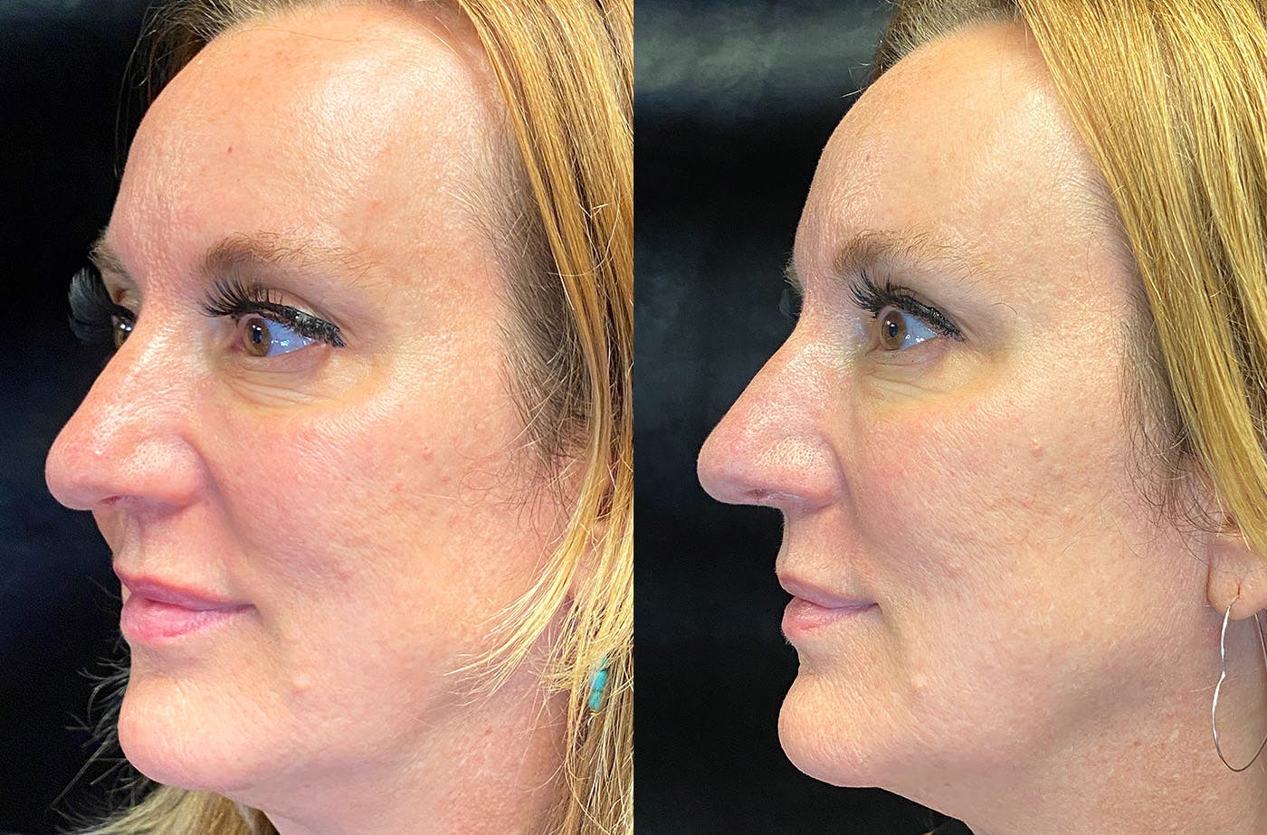 BOTOX/Dysport Before & After Gallery - Patient 148734832 - Image 3