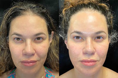 Dermal Fillers Before & After Gallery - Patient 149257240 - Image 1
