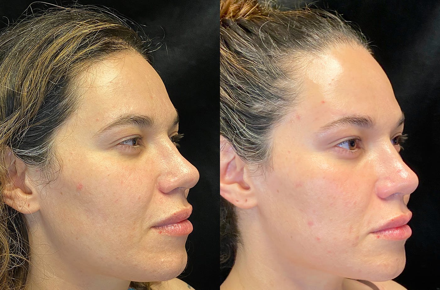 Dermal Fillers Before & After Gallery - Patient 149257240 - Image 2