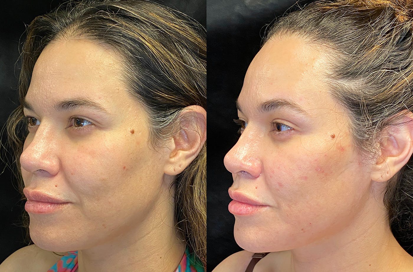 Dermal Fillers Before & After Gallery - Patient 149257240 - Image 3