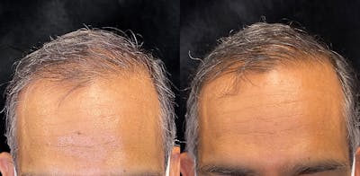 PRP Hair Restoration Before & After Gallery - Patient 154143501 - Image 1