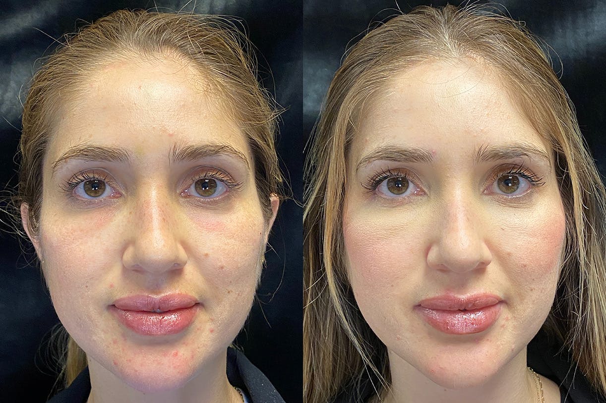 Dermal Fillers Before & After Gallery - Patient 154143524 - Image 1