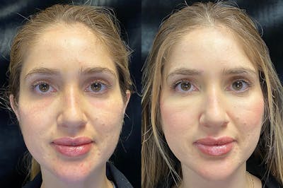 Dermal Fillers Before & After Gallery - Patient 154143524 - Image 1