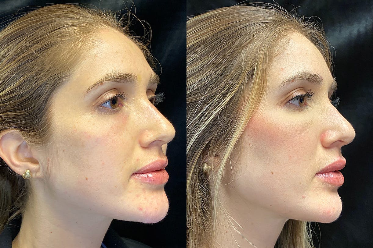 Dermal Fillers Before & After Gallery - Patient 154143524 - Image 2