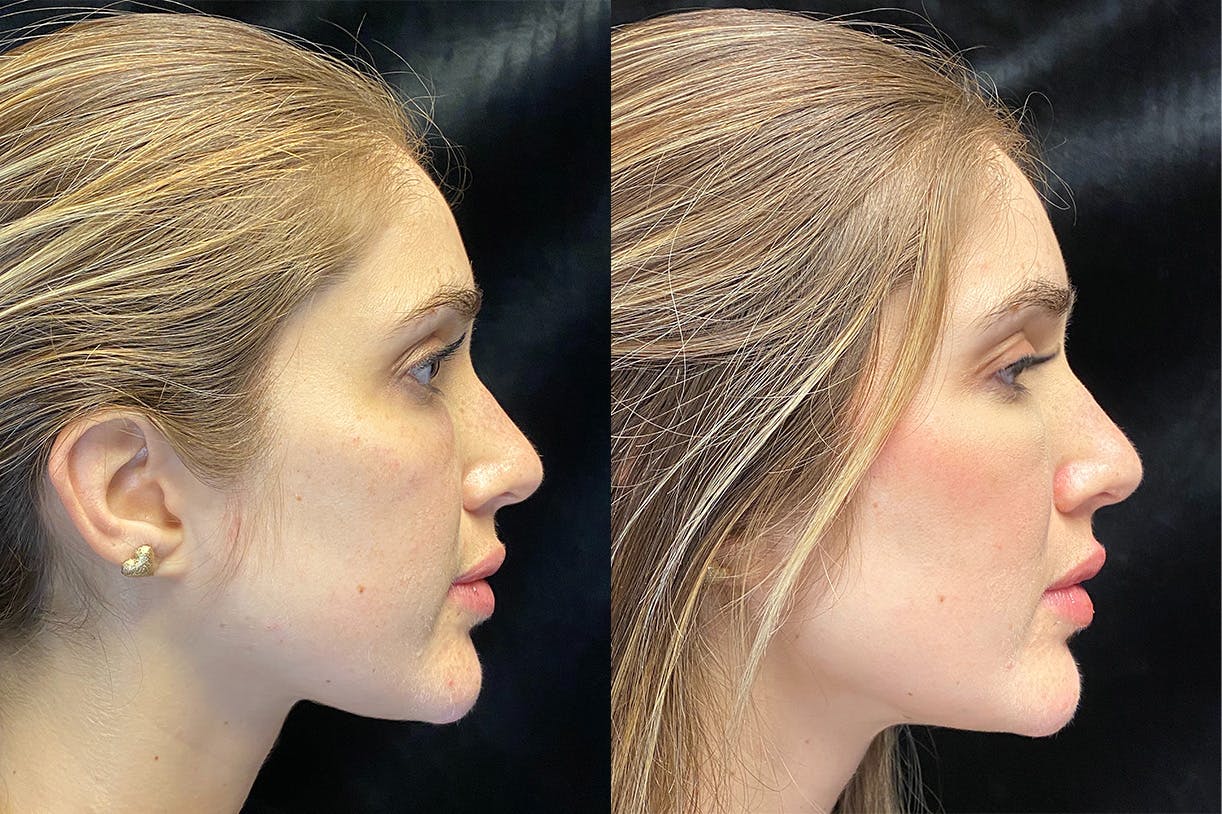 Dermal Fillers Before & After Gallery - Patient 154143524 - Image 3