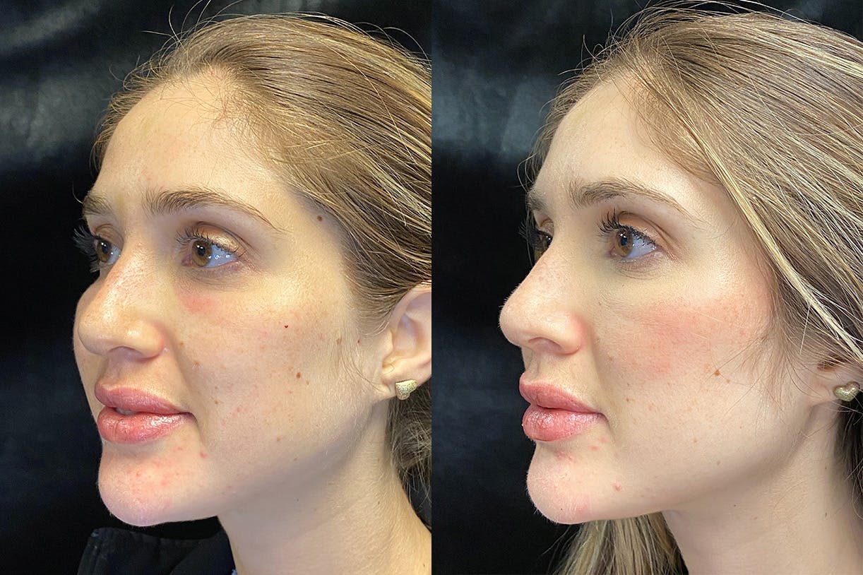 Dermal Fillers Before & After Gallery - Patient 154143524 - Image 4
