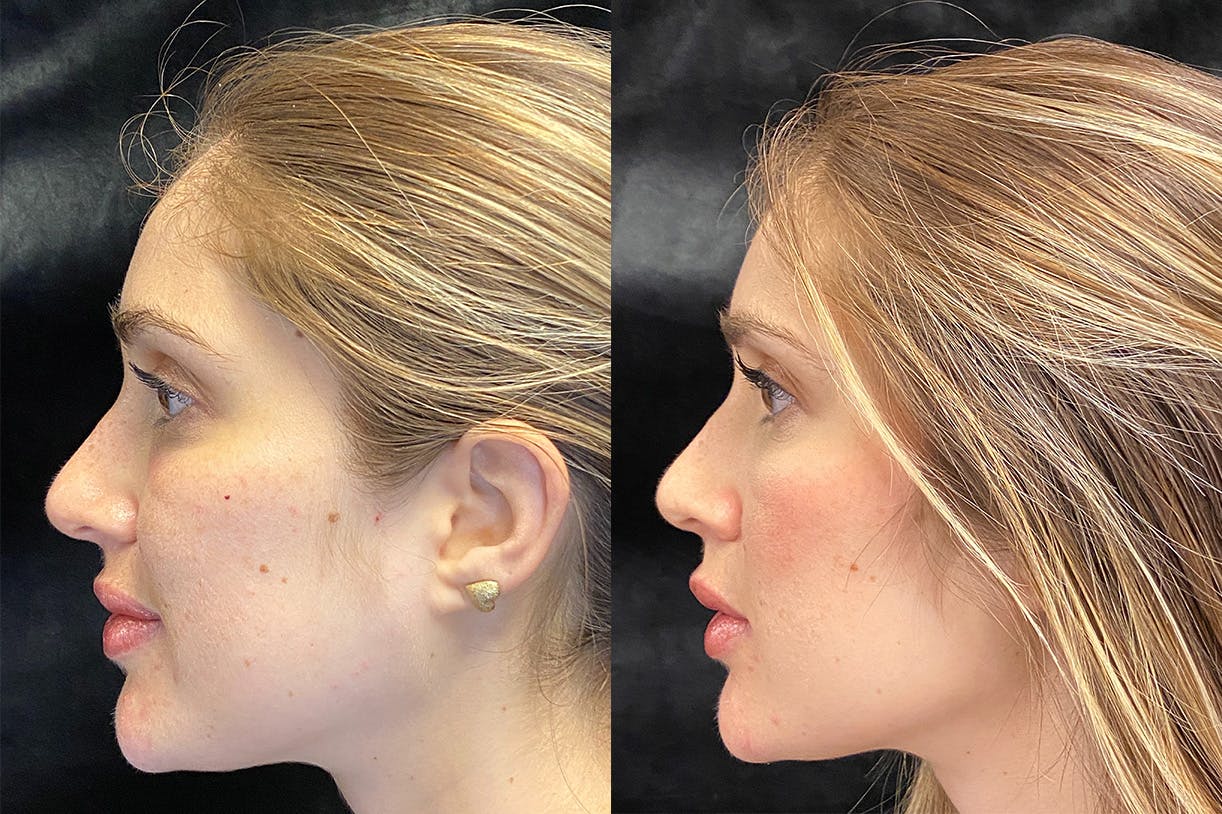 Dermal Fillers Before & After Gallery - Patient 154143524 - Image 5