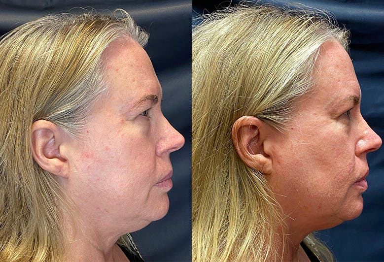 Morpheus8 Before & After Gallery - Patient 154239383 - Image 1