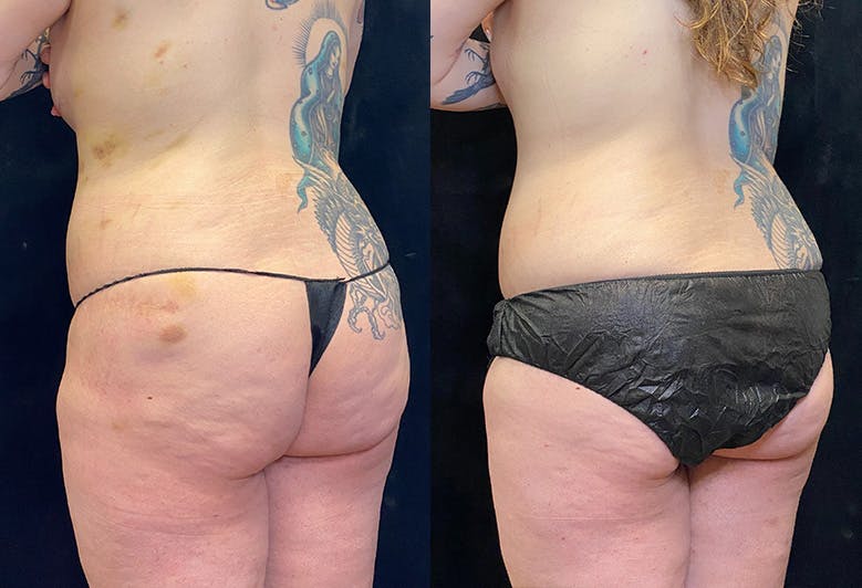 EvolveX Before & After Gallery - Patient 154239386 - Image 2