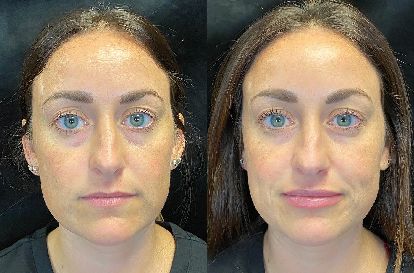 Before & after Botox at Modern Women's Health