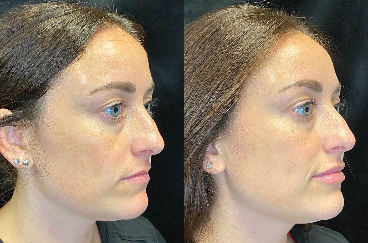 Dermal Fillers Before & After Gallery - Patient 165466711 - Image 2