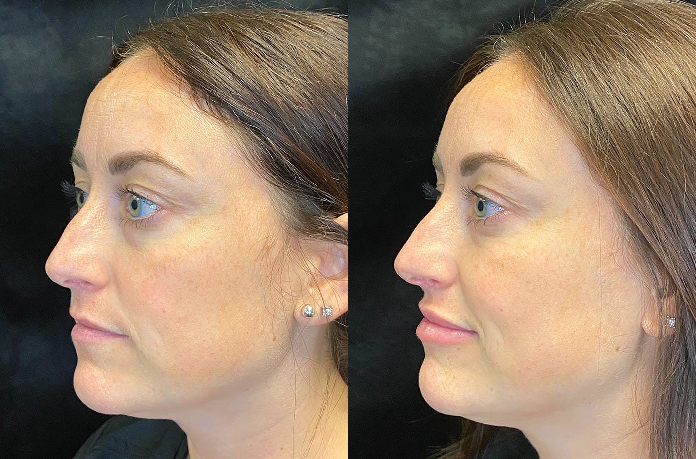 BOTOX/Dysport Before & After Gallery - Patient 165466709 - Image 3