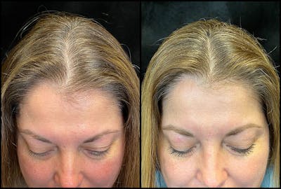 PRP Hair Restoration Before & After Gallery - Patient 172693880 - Image 1