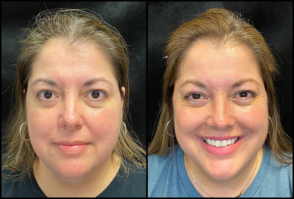 PRP Hair Restoration Before & After Gallery - Patient 172693880 - Image 2