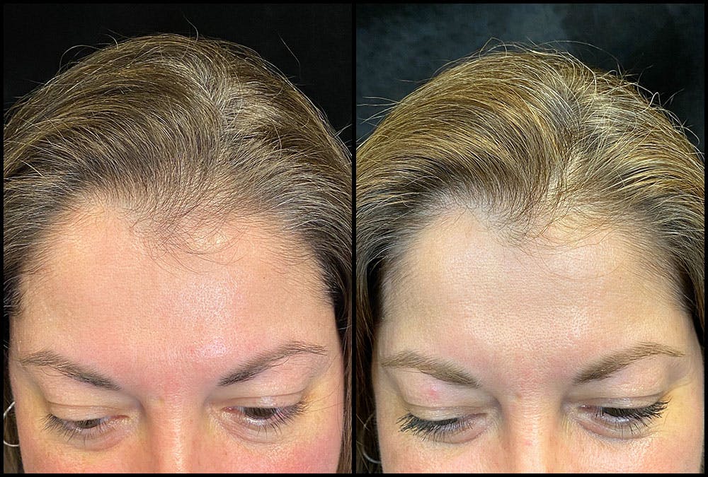 PRP Hair Restoration Before & After Gallery - Patient 172693880 - Image 3