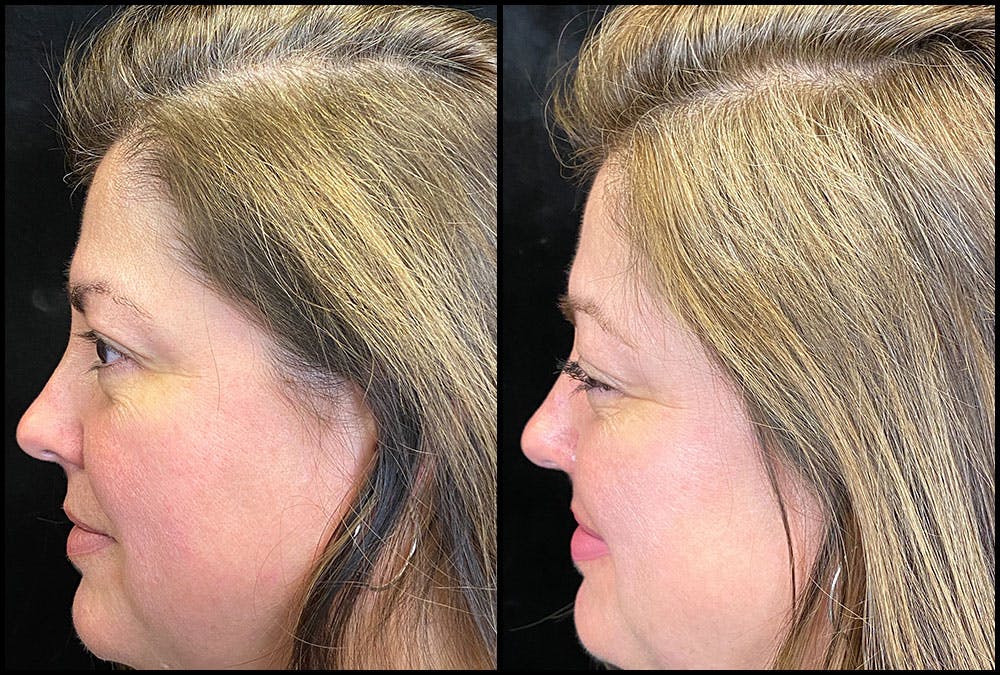 PRP Hair Restoration Before & After Gallery - Patient 172693880 - Image 4