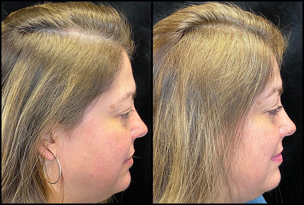 PRP Hair Restoration Before & After Gallery - Patient 172693880 - Image 5
