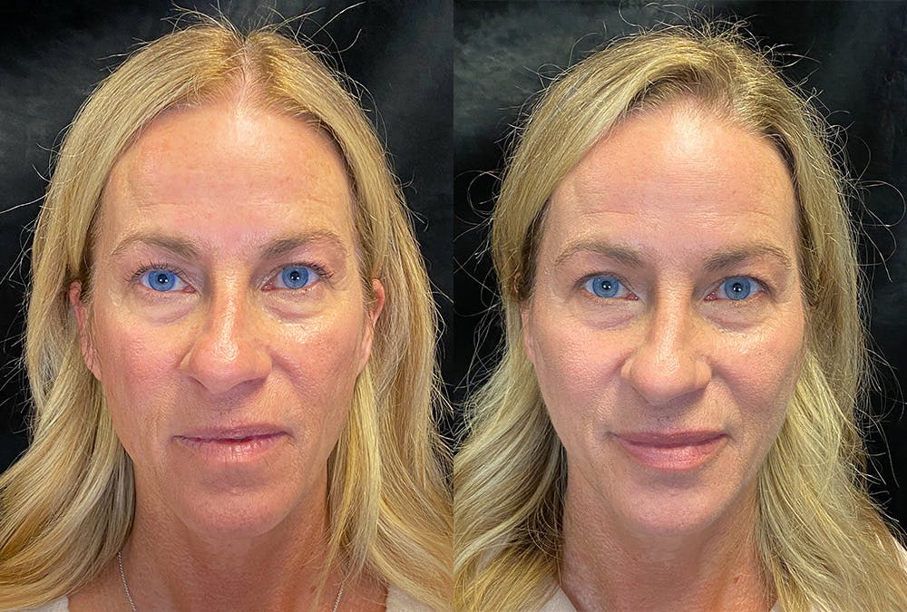 Dermal Fillers Before & After Gallery - Patient 376502 - Image 1