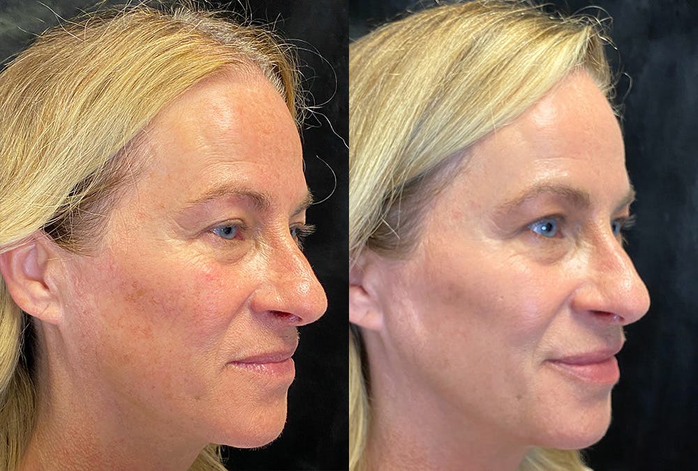 Dermal Fillers Before & After Gallery - Patient 376502 - Image 2