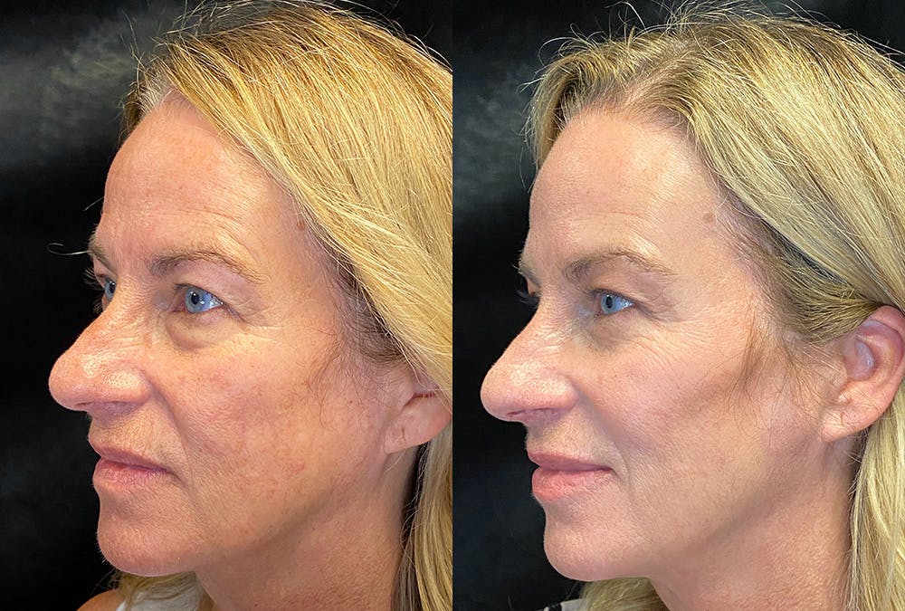 Dermal Fillers Before & After Gallery - Patient 376502 - Image 3