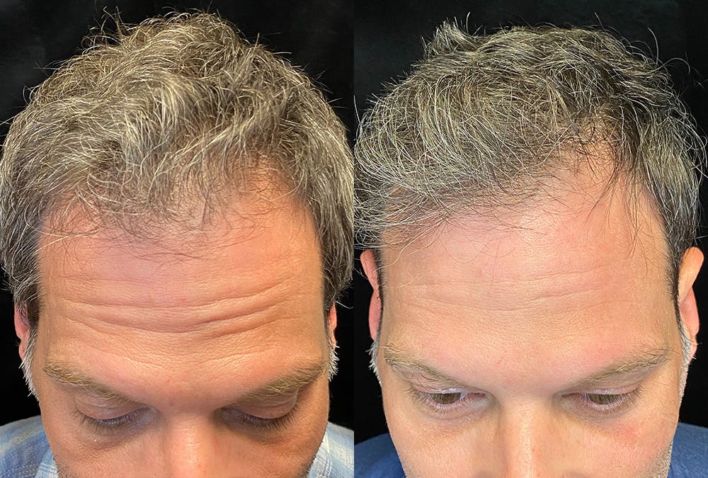 PRP Hair Restoration Before & After Gallery - Patient 145329 - Image 1