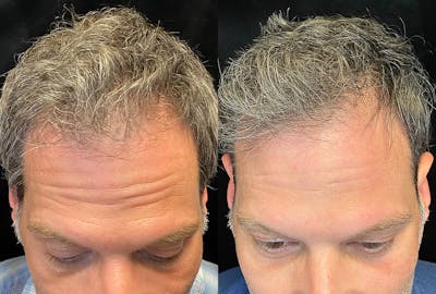 PRP Hair Restoration Before & After Gallery - Patient 145329 - Image 1